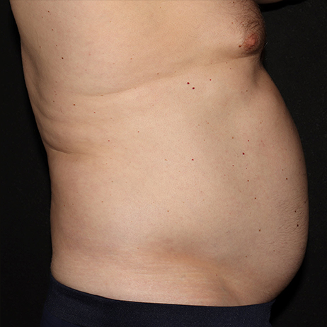 BEFORE Weight Loss and Diet 1 BEFORE Weight Loss and Diet 1
