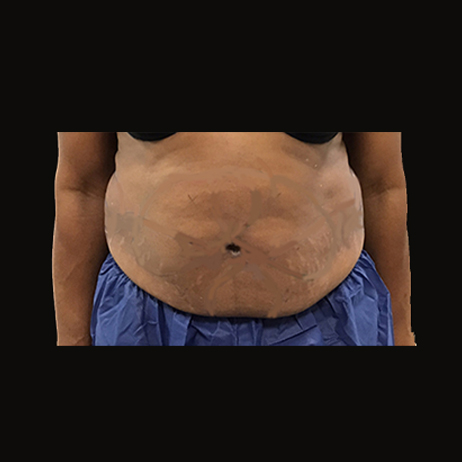 BEFORE Weight Loss and Diet 2 BEFORE Weight Loss and Diet 2