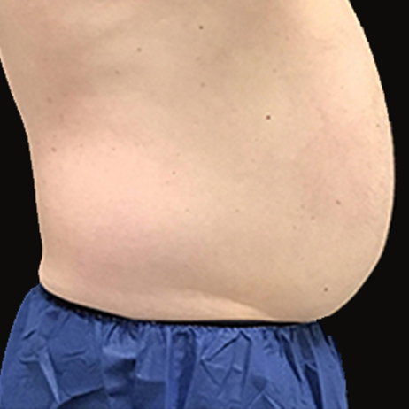 CLIENT #5 Before Weight Loss CLIENT #5 Before Weight Loss