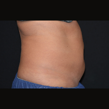 CLIENT #6 Middle After Weight Loss CLIENT #6 Middle After Weight Loss