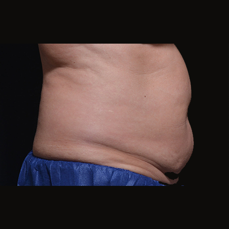CLIENT #6 Middle Before Weight Loss CLIENT #6 Middle Before Weight Loss