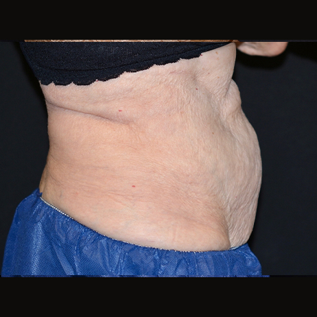 CLIENT 3 After Weight Loss and Diet 2 CLIENT 3 After Weight Loss and Diet 2