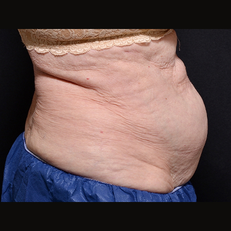 CLIENT 3 BEFORE Weight Loss and Diet 2 CLIENT 3 BEFORE Weight Loss and Diet 2