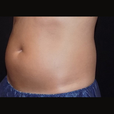 Client 4 - BEFORE Weight Loss and Diet 2 Client 4 - BEFORE Weight Loss and Diet 2