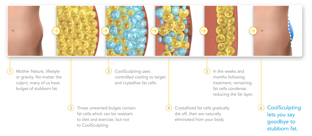 CoolSculpting Process