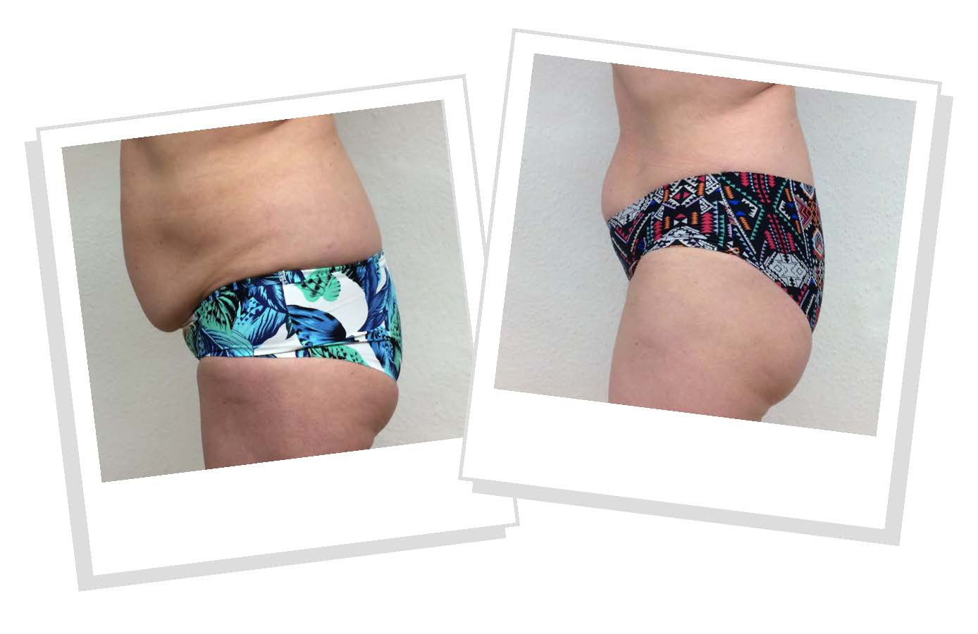 Emerald Green Laser Before and After Photos Orlando 1 Emerald Green Laser Before and After Photos Orlando 1