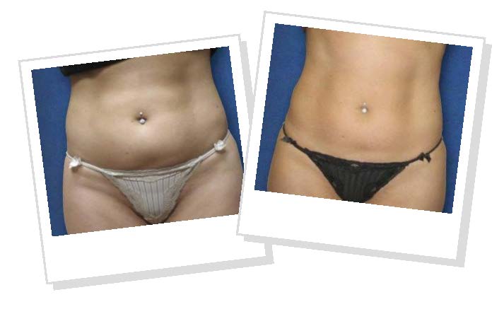 Emerald Green Laser Before and After Photos Orlando 2 Emerald Green Laser Before and After Photos Orlando 2