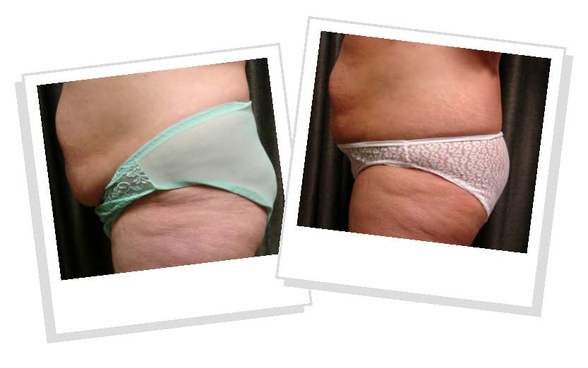 Emerald Green Laser Before and After Photos Orlando 3 Emerald Green Laser Before and After Photos Orlando 3